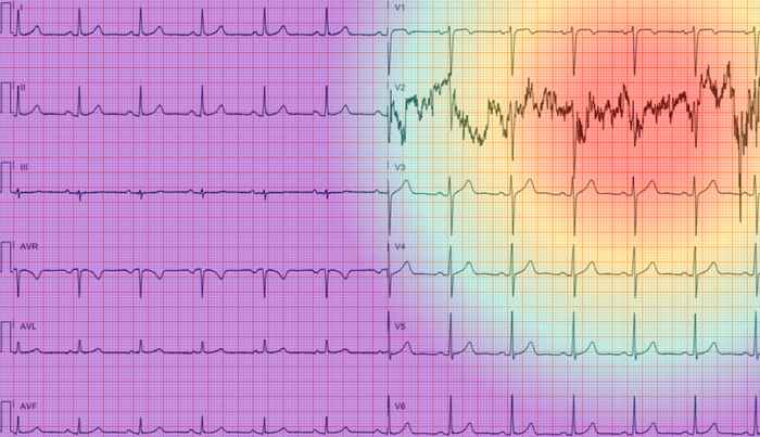Saliency map explanation for an ECG exam that is predicted to be low-quality. Red highlights the part of the image most important to the model's prediction, while purple indicates the least important area.